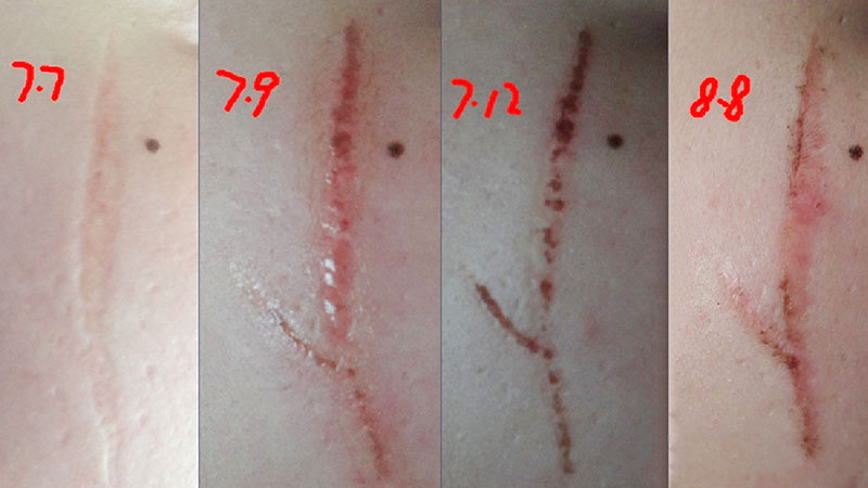 WilliamHill中文官方网站除疤