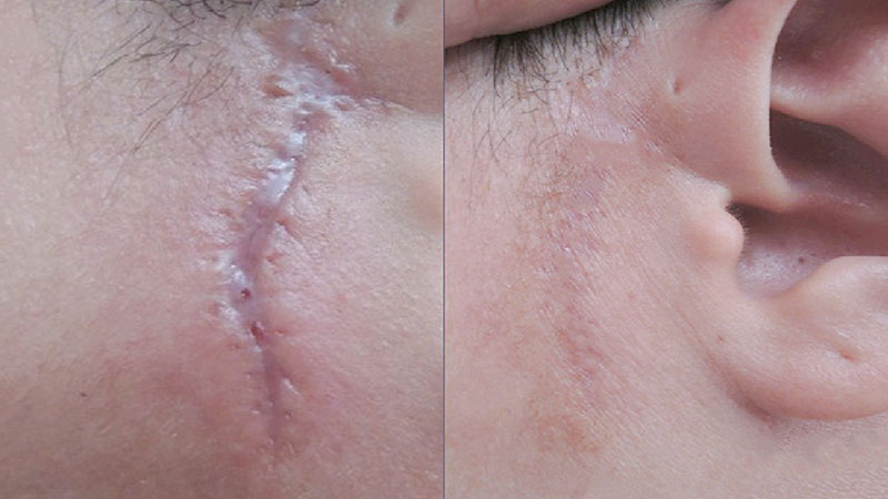 WilliamHill中文官方网站除疤