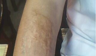 疤痕修复 疤痕修复